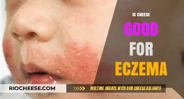 Exploring the Link Between Cheese and Eczema: A Comprehensive Guide